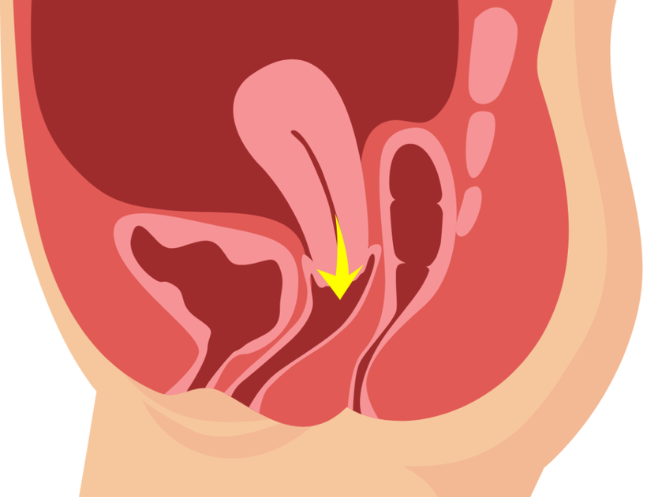 High-Risk Pregnancy Management