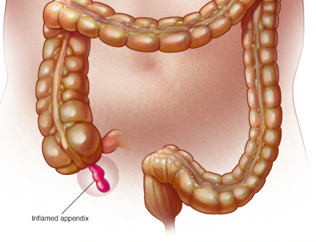 Colorectal Conditions