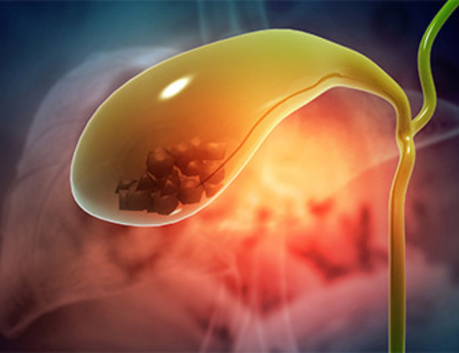 Gallbladder Stones