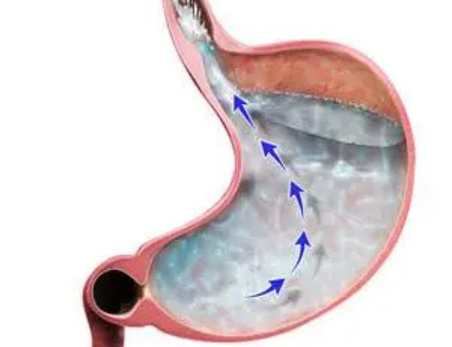 GERD/Hiatal Hernia