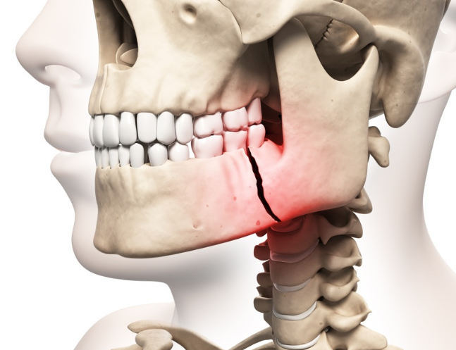 Facial Trauma Surgery