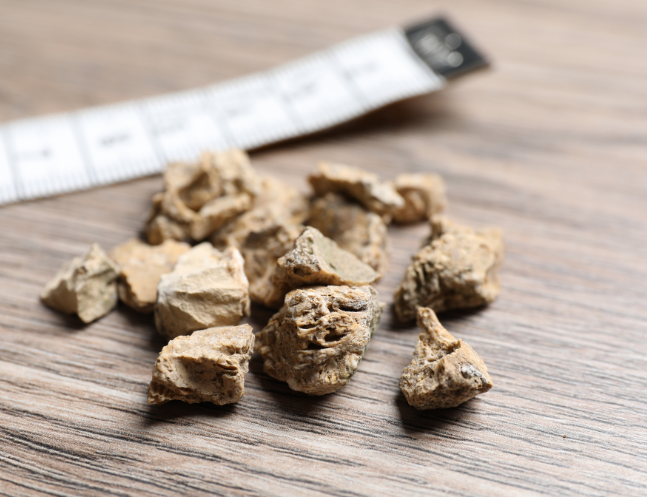 Kidney Stones